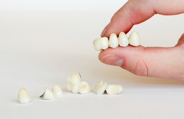 Răng sứ Titan độ tuổi thọ trung bình khoảng 5 – 8 năm
