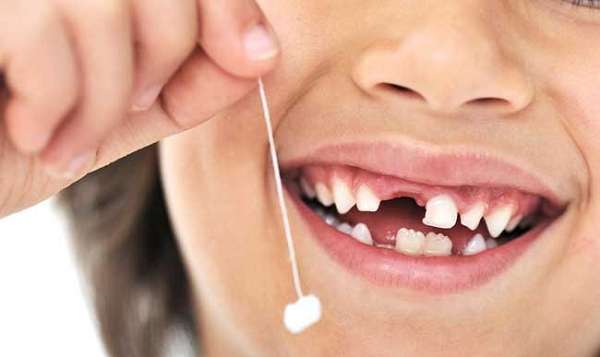 Răng sữa sẽ quyết định vị trí mọc của răng vĩnh viễn