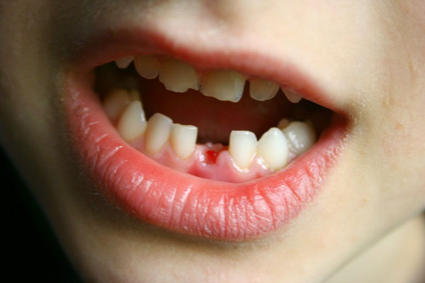 Răng sữa được thay thế từ khoảng 6 – 12 tuổi