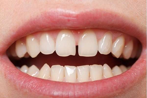 Răng bị thưa có nhiều nguyên nhân khác nhau