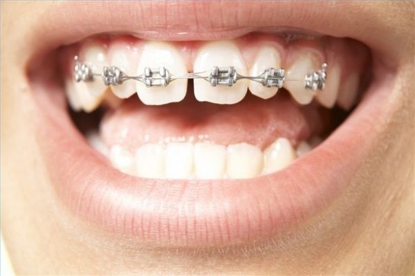 Bệnh nhân bị răng thưa không cần thiết phải nhổ răng