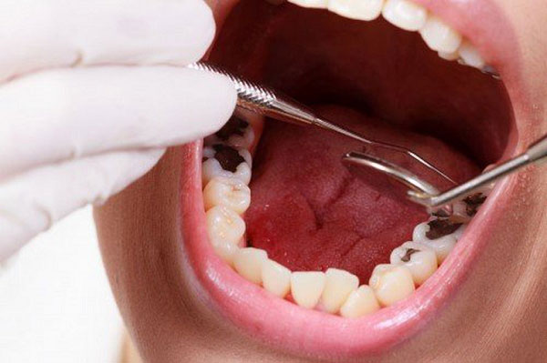 Sâu răng có thể là nguyên nhân khiến bạn bị ê buốt răng