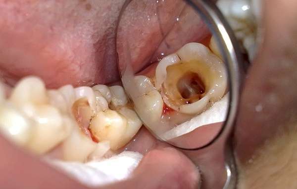Sâu răng là một trong những nguyên nhân khiến răng sứ kém bền chắc