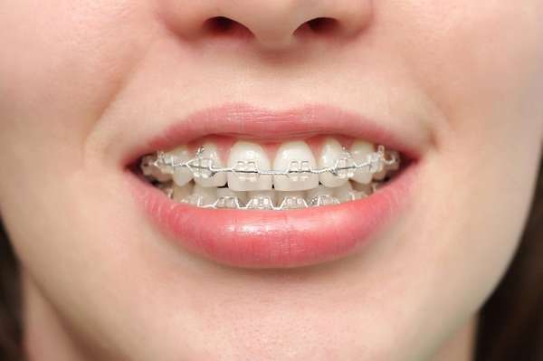 Thời gian chỉnh nha của các phương pháp niềng răng không chênh lệch nhiều