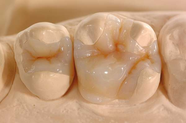 Phương pháp trám răng inlay và onlay có nhiều khác biệt so với trám răng thông thường