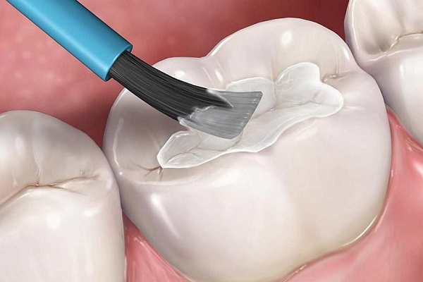 Trám răng sâu sẽ giúp hạn chế sâu răng phát triển