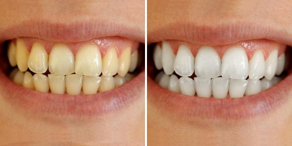 Ảnh trước và sau khi tẩy trắng răng