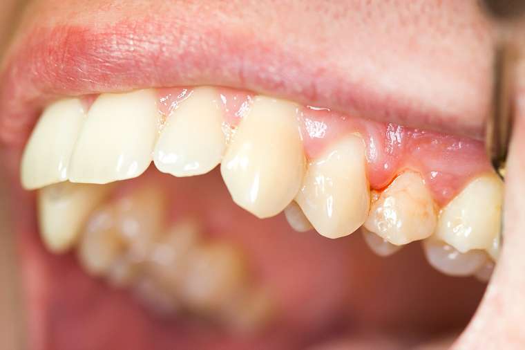 Viêm lợi sau khi bọc răng sứ ảnh hưởng đến tính thẩm mỹ và sức khỏe
