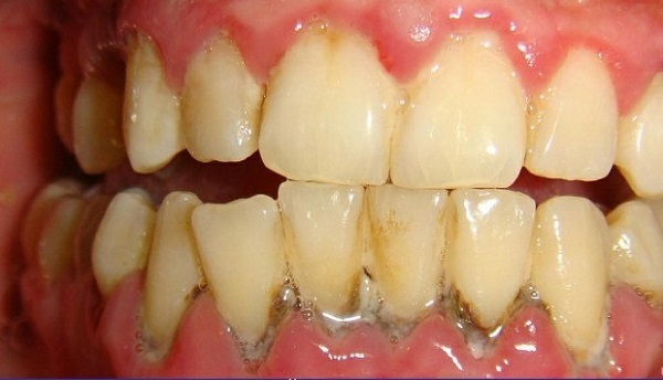 Răng bị viêm nha chu quá nặng gây nên tình trạng răng bị lung lay