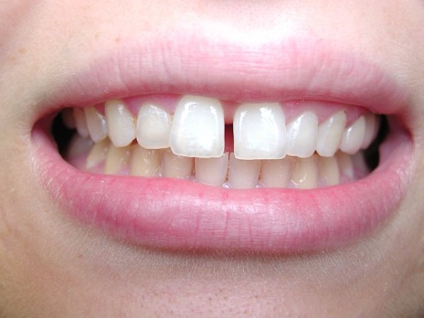 Chữa răng cửa thưa có nhiều phương pháp khác nhau
