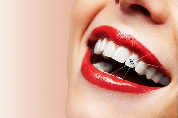 Đính đá vào răng vị trí nào là đẹp phụ thuộc vào tình trạng răng miệng