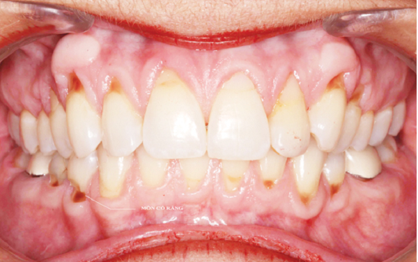 Mòn cổ chân răng là hiện tượng mất men răng ở vị trí cổ răng