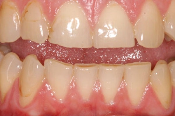 Bệnh nghiến răng sẽ làm mòn răng