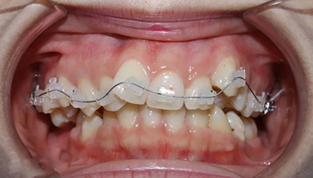 Niềng răng bị mọc lạc khỏi cung hàm