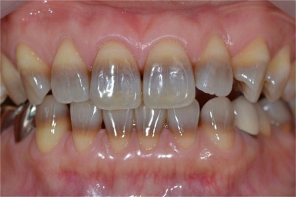 Răng bị nhiễm màu kháng sinh Tetracyline