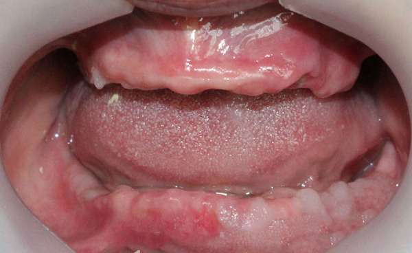 Tình trạng tiêu xương do mất răng lâu ngày