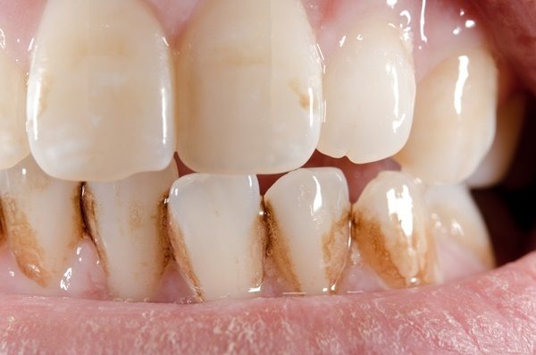 Nguyên nhân gây mảng bám trên răng
