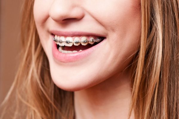 Bị hô nên niềng răng hay phẫu thuật để đạt hiệu quả tốt nhất?
