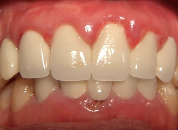 Bọc răng sứ bị viêm lợi có thể dẫn tới tình trạng viêm quanh răng và mất răng
