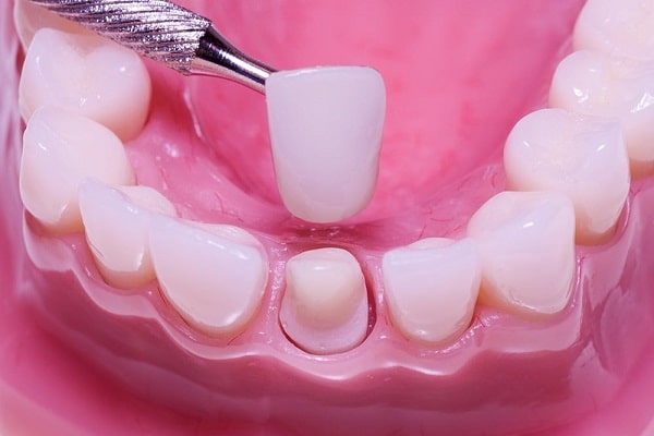 Nên bọc răng sứ sau khi trám răng để bảo vệ vết trám răng