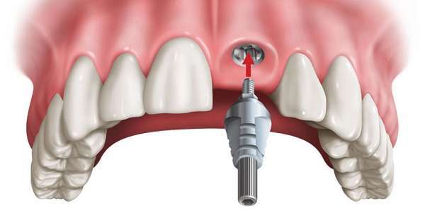 Trường hợp răng đã mất là răng vĩnh viễn sẽ cần cắm implant