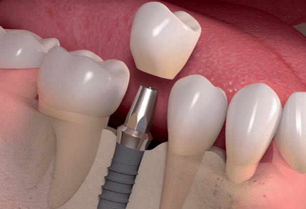 Trường hợp đã cấy ghép răng Implant thì không thể niềng răng thẩm mỹ