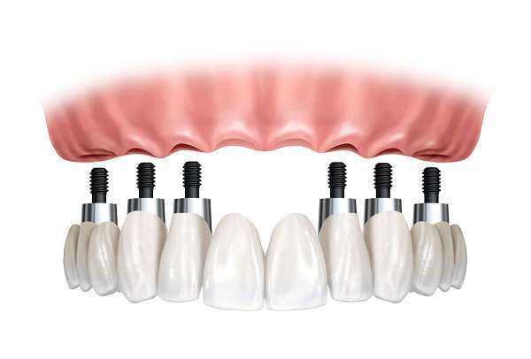 Cấy 6 implant cho toàn hàm (All on 6)