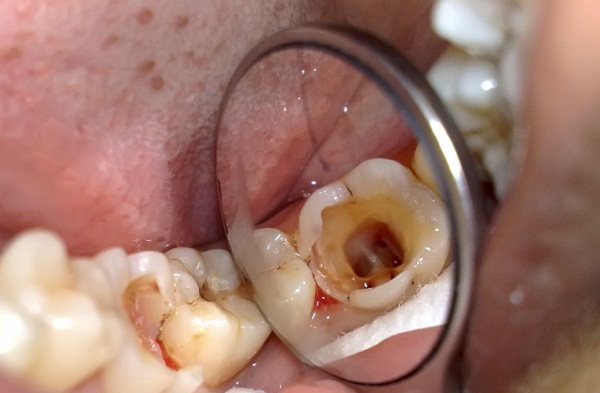 Răng sâu lâu ngày dẫn đến viêm tủy