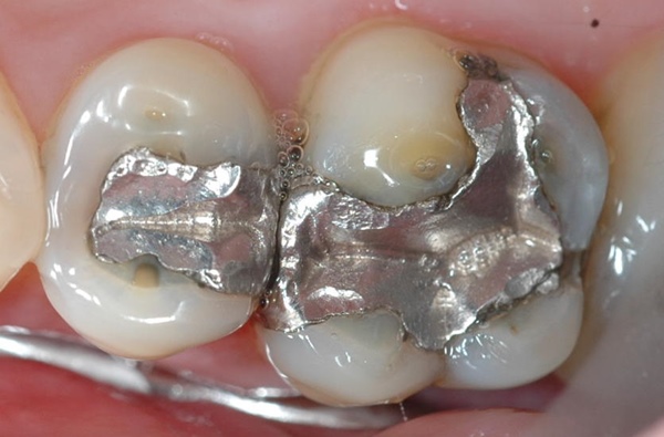 Trám răng bằng chì thường được dùng cho răng hàm