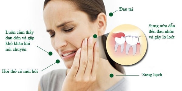 Răng khôn mọc lệch nếu không nhổ bỏ kịp thời sẽ ảnh hưởng đến răng khác