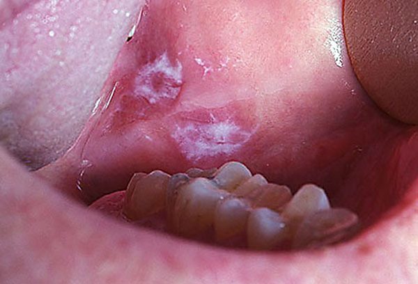 Lão hóa răng ở người già có thể dẫn đến thoái hóa niêm mạc miệng