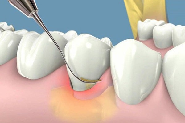 Lấy cao răng khắc phục và ngăn chặn tình trạng chân răng bị viêm, nhiễm
