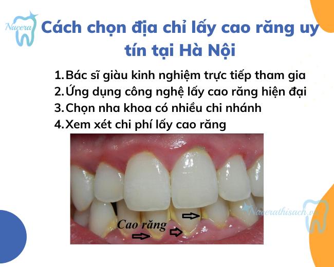 Cách chọn địa chỉ lấy cao răng uy tín tại Hà Nội