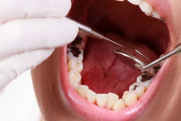 Điều trị tác động đến ngà răng, do vậy sẽ có chút đau khi chữa răng sâu