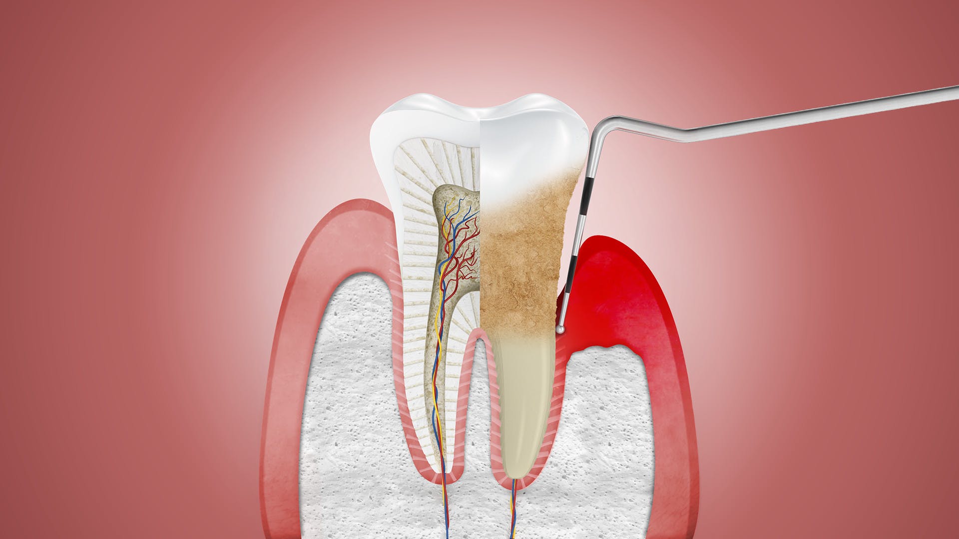 Bệnh nha chu là một bệnh nhiễm trùng gây phá hủy mô nâng đỡ quanh răng