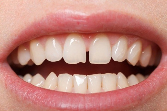 Niềng răng là giải pháp hiệu quả để giải quyết tình trạng răng thưa