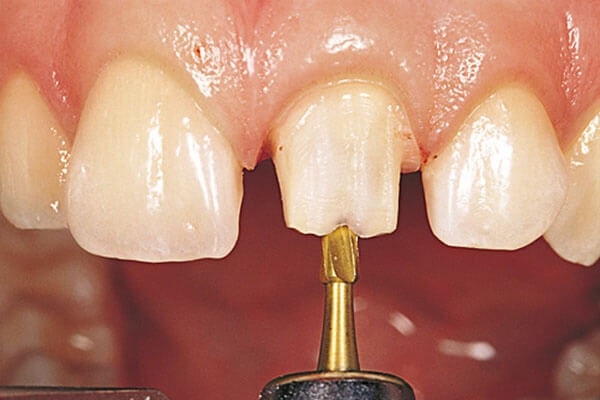 Cầu răng sứ có tuổi thọ trong bao lâu phụ thuộc vào chất lượng cùi răng thật