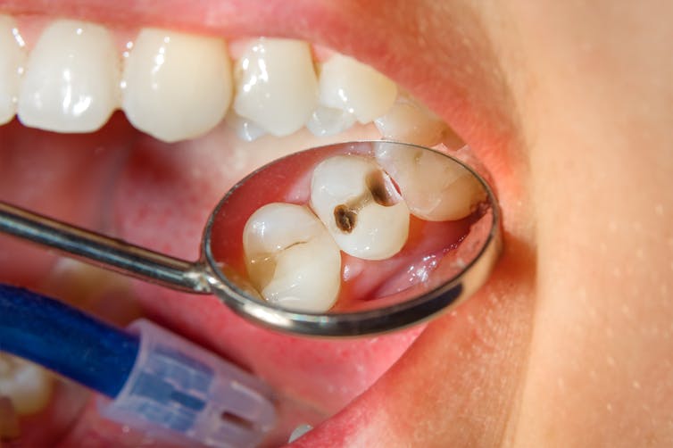 Nhổ bỏ răng cấm bị sâu có nguy hiểm không?