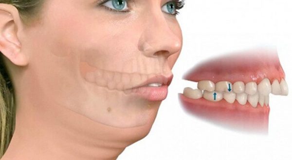 Răng hô do khung hàm niềng răng thẩm mỹ sẽ không có hiệu quả