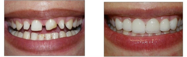 Răng bị mẻ lớn có bọc răng sứ được không? còn phụ thuộc vào tình trạng bệnh nhân