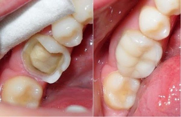 Răng bị mẻ cần được điều trị sớm để tránh những hậu quả nghiêm trọng về sau