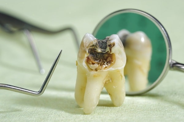 Nếu răng bị sâu nặng cần điều trị tủy trước khi tiến hành bọc răng sứ