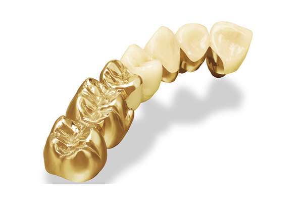  Răng sứ kim loại quý