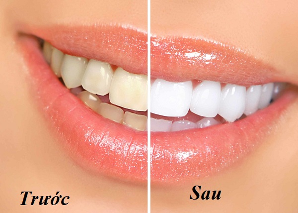 Trước và sau khi tẩy trắng răng