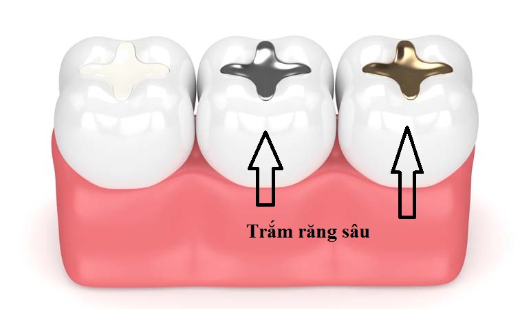 Quy trình trám răng sâu gồm 4 bước