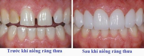 Trước và sau khi niềng răng thưa thẩm mỹ
