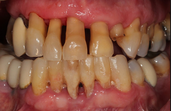 Người mắc bệnh viêm nha chu nặng không thể niềng răng thẩm mỹ