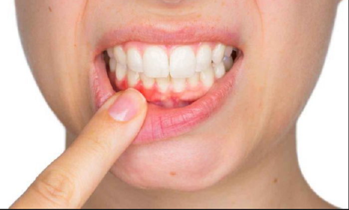 Cao răng là nguyên nhân của nhiều bệnh lý răng miệng