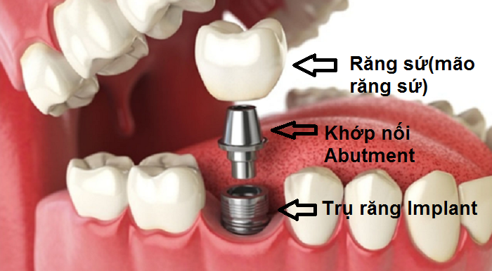 Cấu tạo răng implant gồm 3 phần