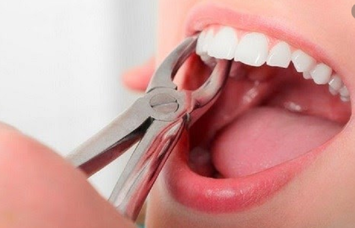 Nhổ răng trước khi niềng răng khấp khểnh có cần thiết không?